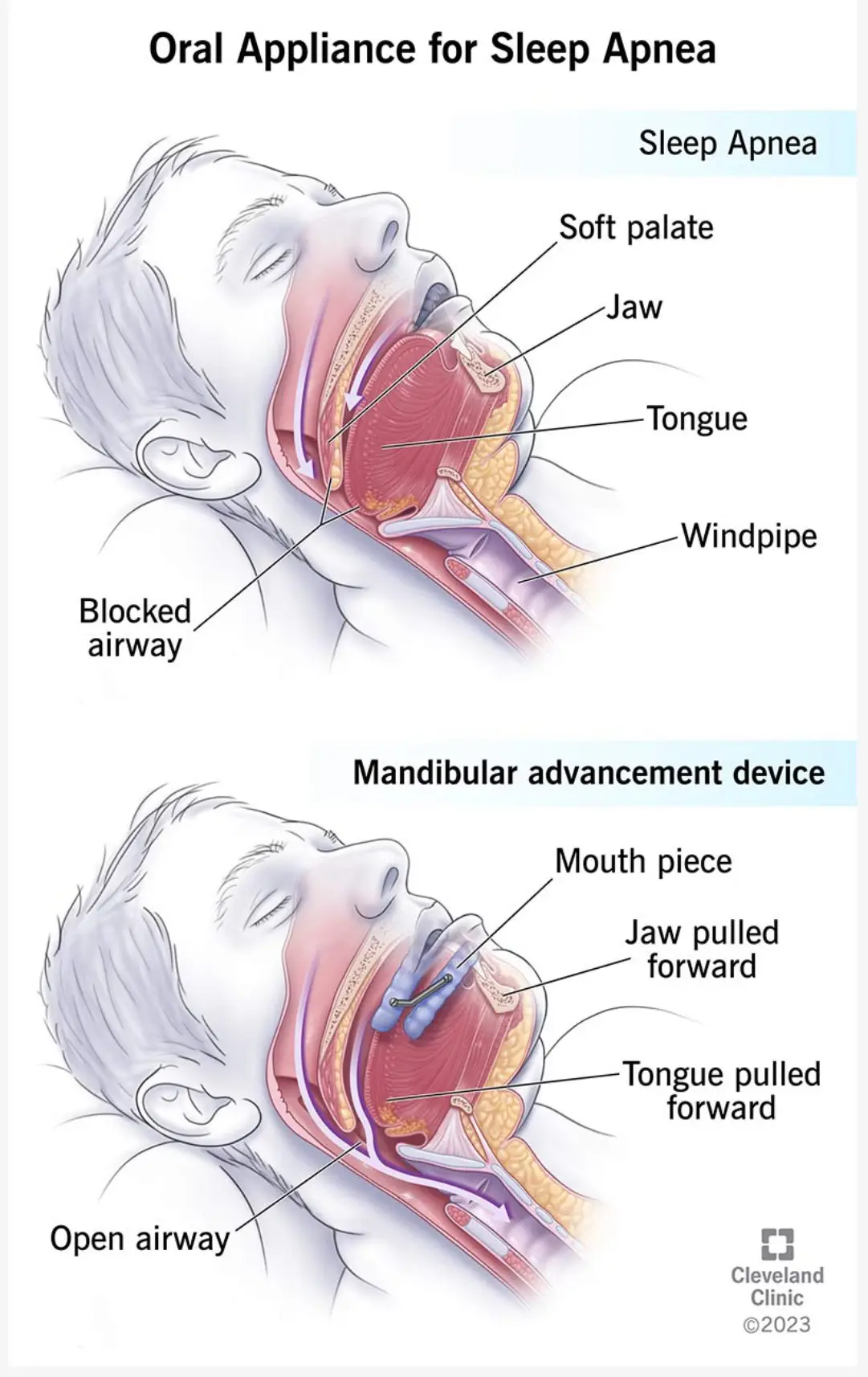 Oral appliance therapy for sleep apnea showing mandibular advancement device improving airway by repositioning jaw and tongue.